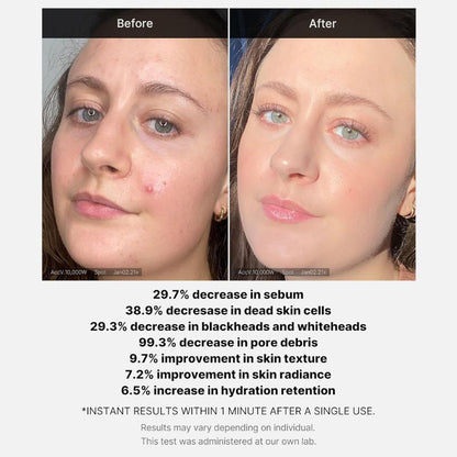 Medicube Red Acne Succinic Acid Peel 40g - GlossyGlams